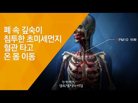 폐 속 깊숙이 침투한 초미세먼지, 혈관 타고 온 몸 이동 – (20150311_537회 방송)_보이지 않는 적, 미세먼지